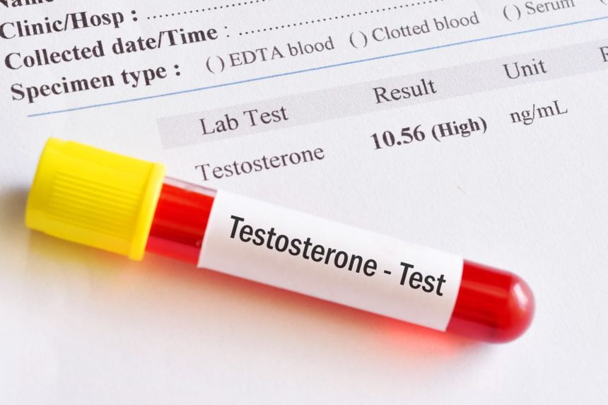 Male Testosterone deficiency Test